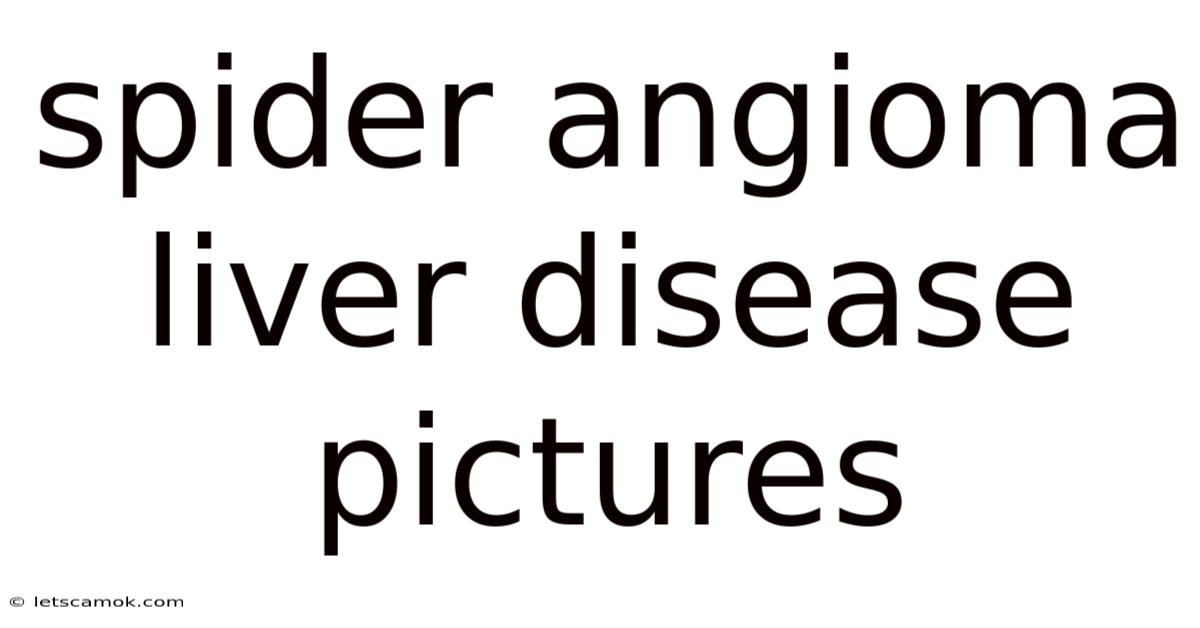 Spider Angioma Liver Disease Pictures